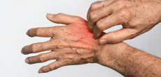 Psoriasis Treatment Appointment Near McLean, VA: Relief Options